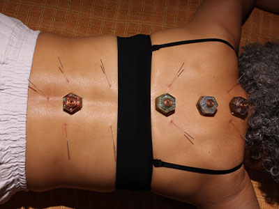Acupuntura